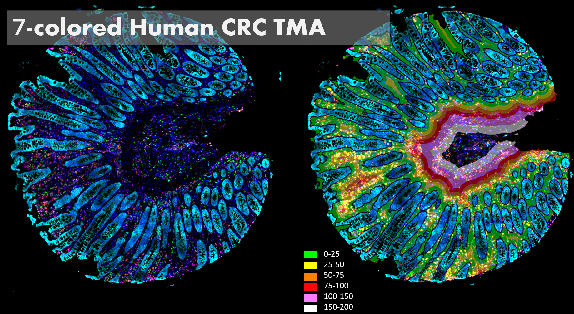 腫瘤微環境分析